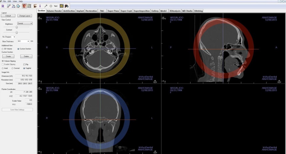 Axial·Coronal·Sagittal 세 축으로 정렬한 안면비대칭 3D CT