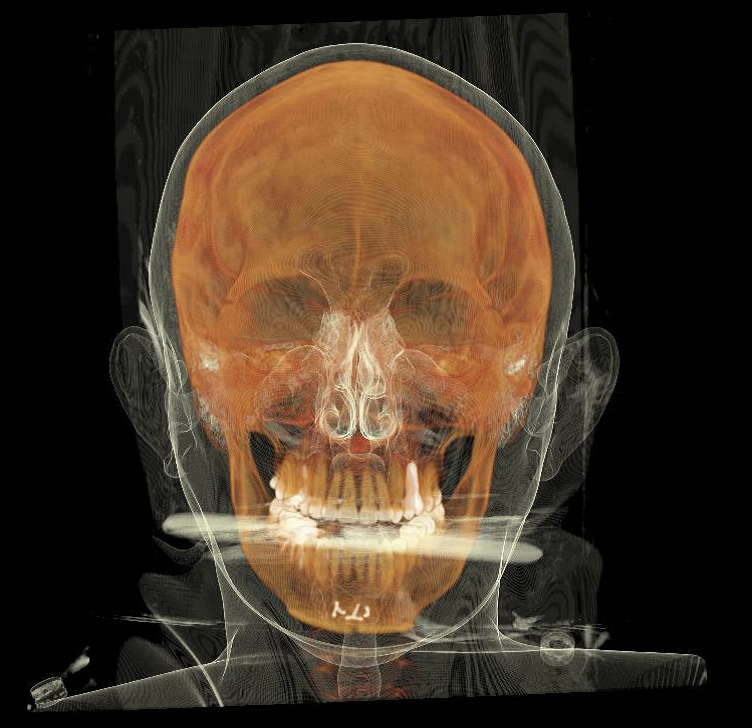턱끝 T절골 중심과 피부 음영을 중첩한 3D CT