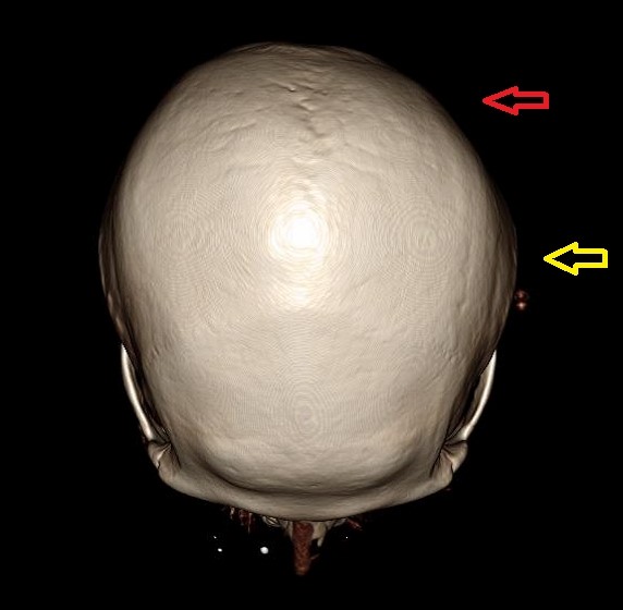 정수리 방향에서 본 후두부 좌우 비대칭 3D CT