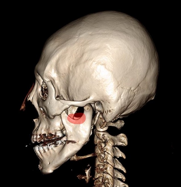 좌측에서 확인한 하악각 잔존량과 반대편 골격 3D CT