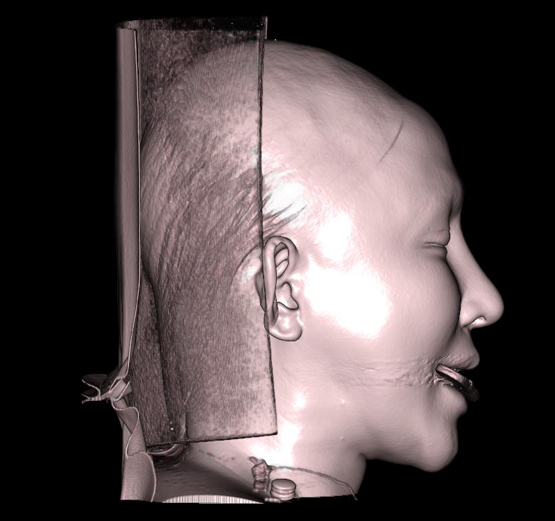 치아 금속 노이즈가 보이는 안면비대칭 측면 피부 3D CT