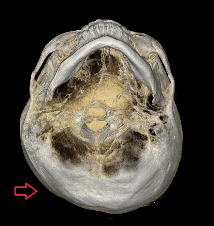 두개저부터 후두부까지 비대칭이 보이는 아래쪽 3D CT