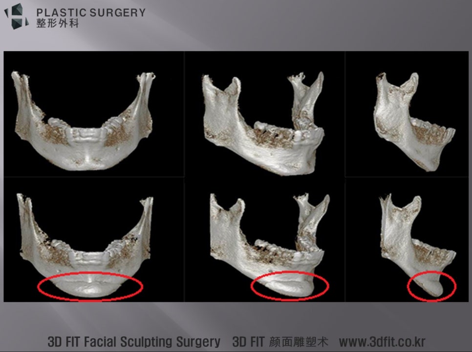 아래쪽 3D CT에서 확인한 턱끝 길이 연장과 보형물 적합도
