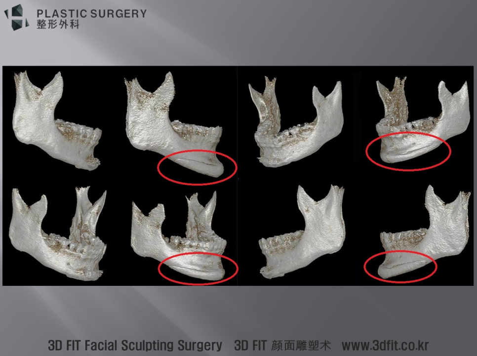 턱끝 골격에 이격 없이 맞춘 3D Fit 무턱 보형물