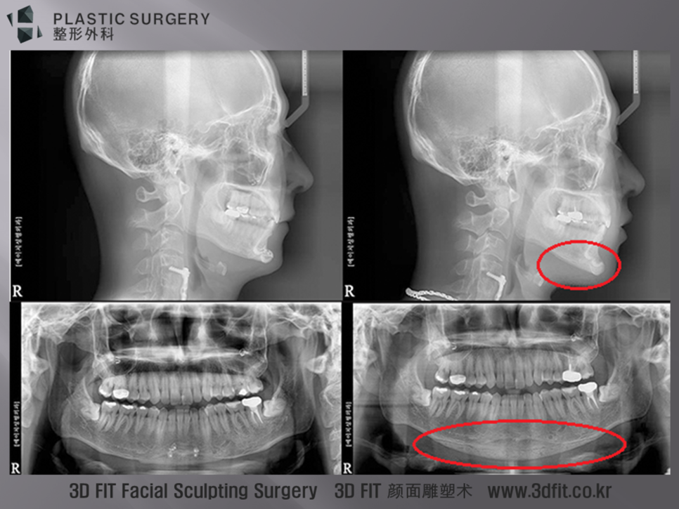 이전 전진술 후 턱끝 길이를 연장한 3D Fit 보형물 X-ray