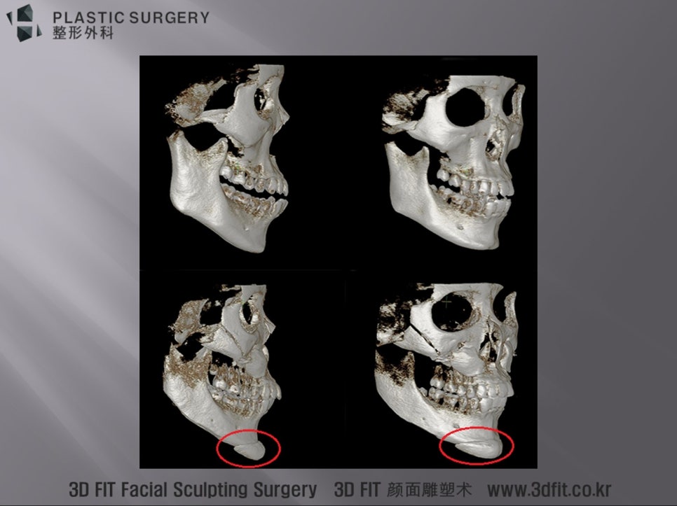 위치 변화 없이 골격에 맞은 3D Fit 턱끝 보형물 3D CT
