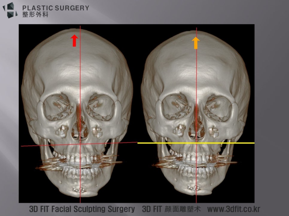 편안한 자세와 영상학적 수평으로 비교한 수술 전 3D CT