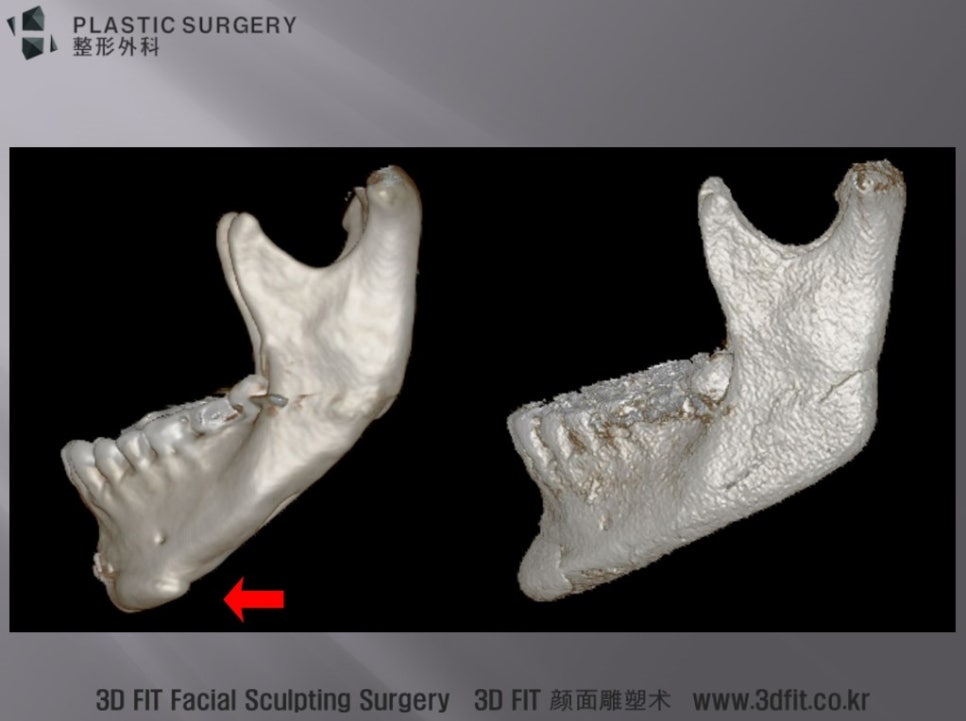 계단현상·돌출 골편·과절제 하악각 재건 전후 3D CT