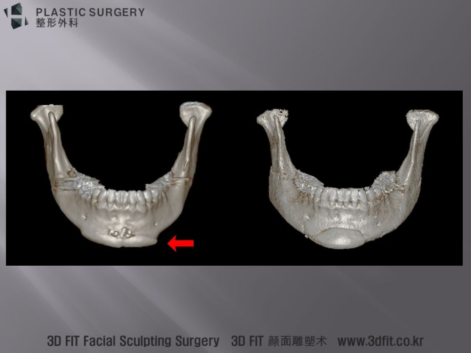 안면비대칭 사각턱 재건 전후 정면 3D CT와 중심선