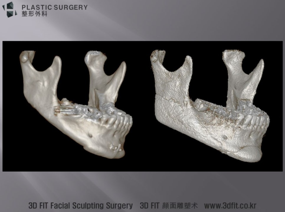 우사면에서 확인한 3D Fit 하악각 재건과 매끄러운 턱선