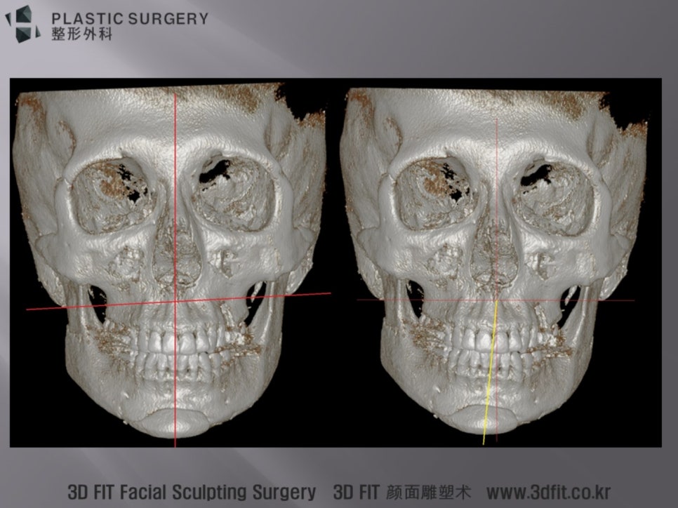 편안한 자세와 유양돌기 수평으로 비교한 수술 후 3D CT