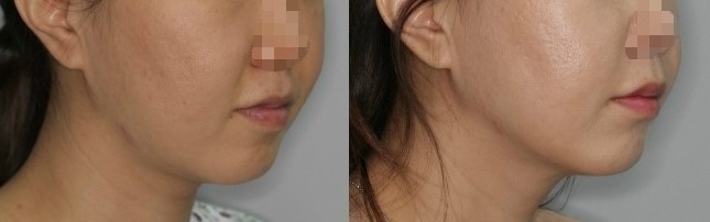 노블캣 재수술 전후 사면 사진