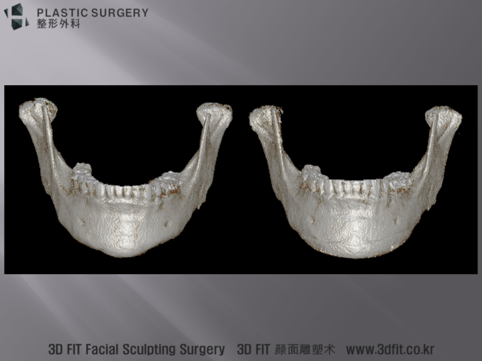 3D Fit 보형물로 좌우 함몰을 대칭적으로 재건한 정면 3D CT