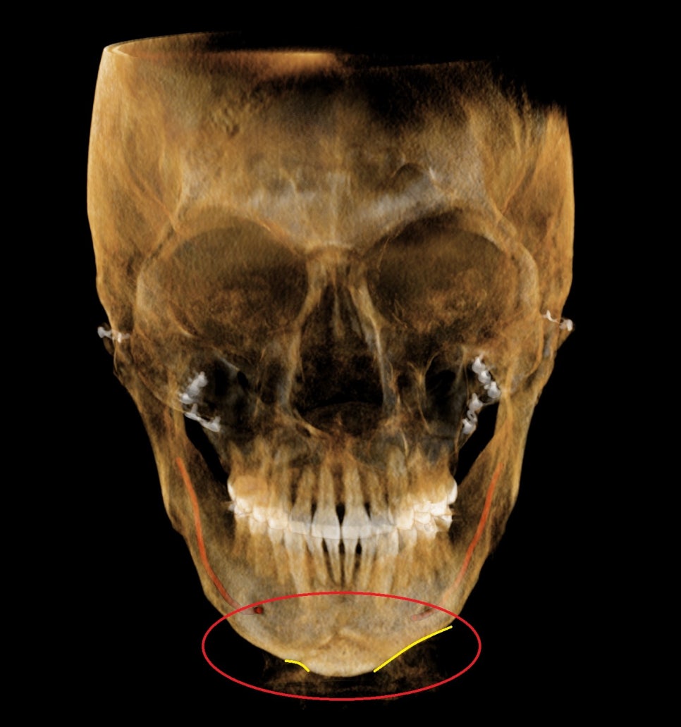 턱끝 ㅅ절골 후 좌우 함몰과 비대칭이 보이는 정면 3D CT