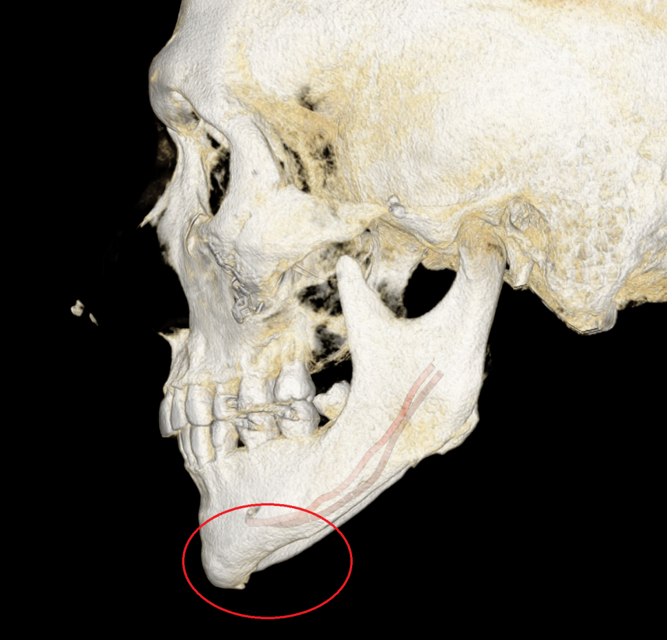 신경관 아래 골삭제량 차이를 확인한 좌측 3D CT