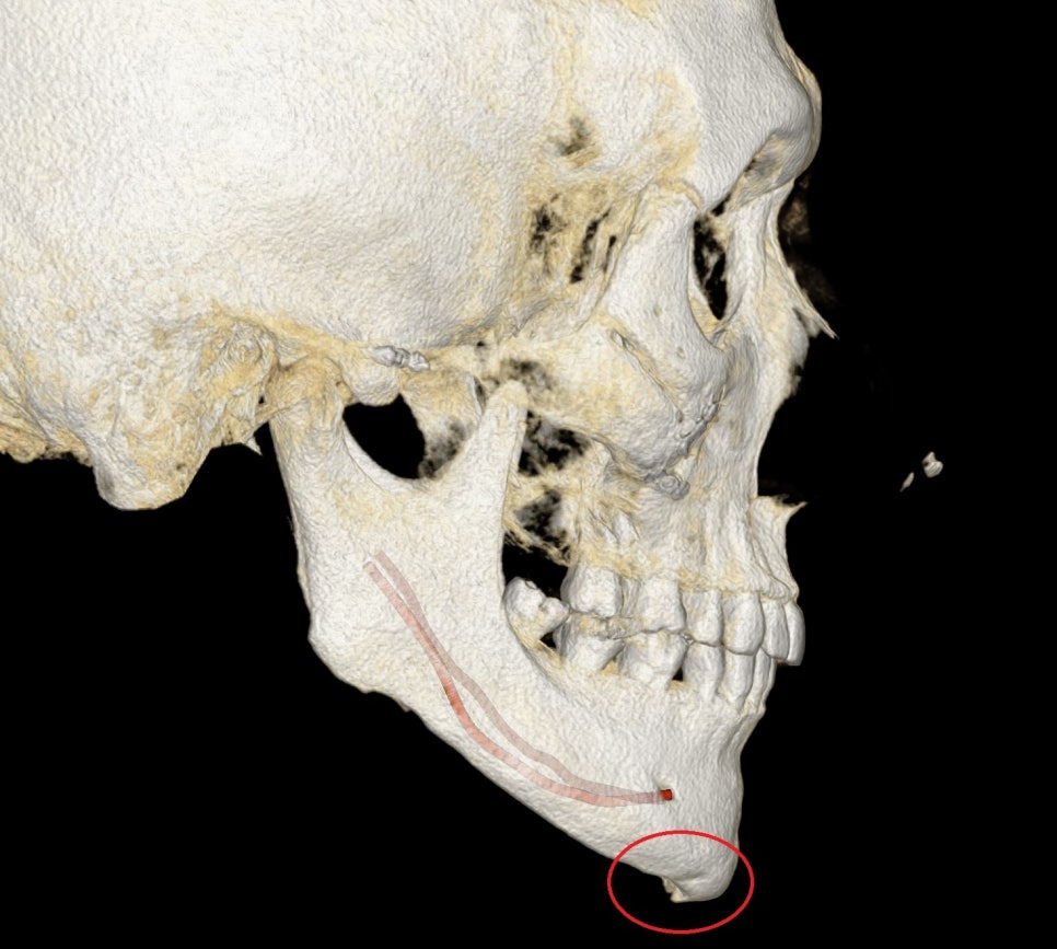 턱끝 ㅅ절골 부위 함몰과 계단현상이 보이는 우측 3D CT