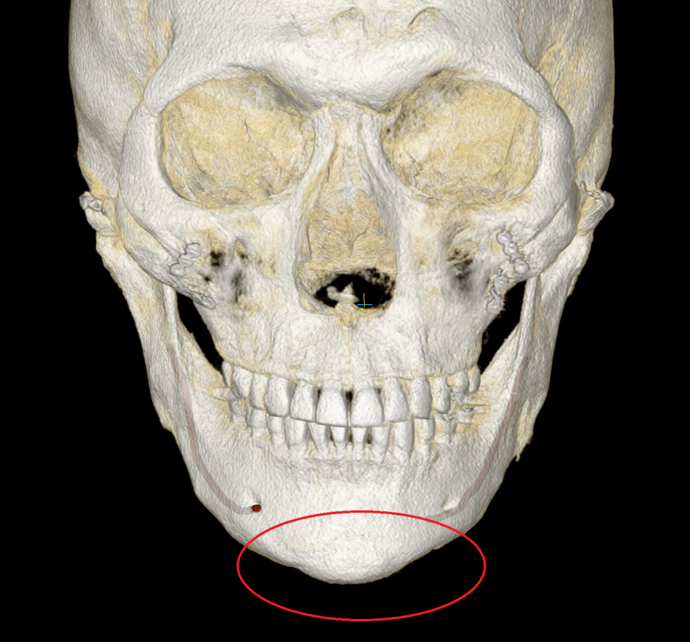 과도하게 좁아진 턱끝과 좌우 비대칭 정면 3D CT