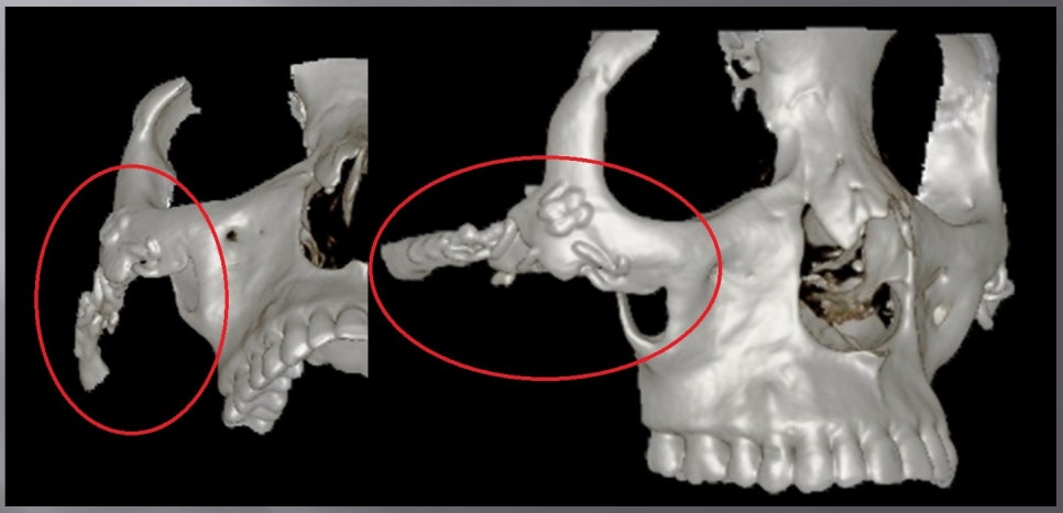 자가골 광대 재건 후 골흡수와 다수 금속 고정물이 보이는 3D CT