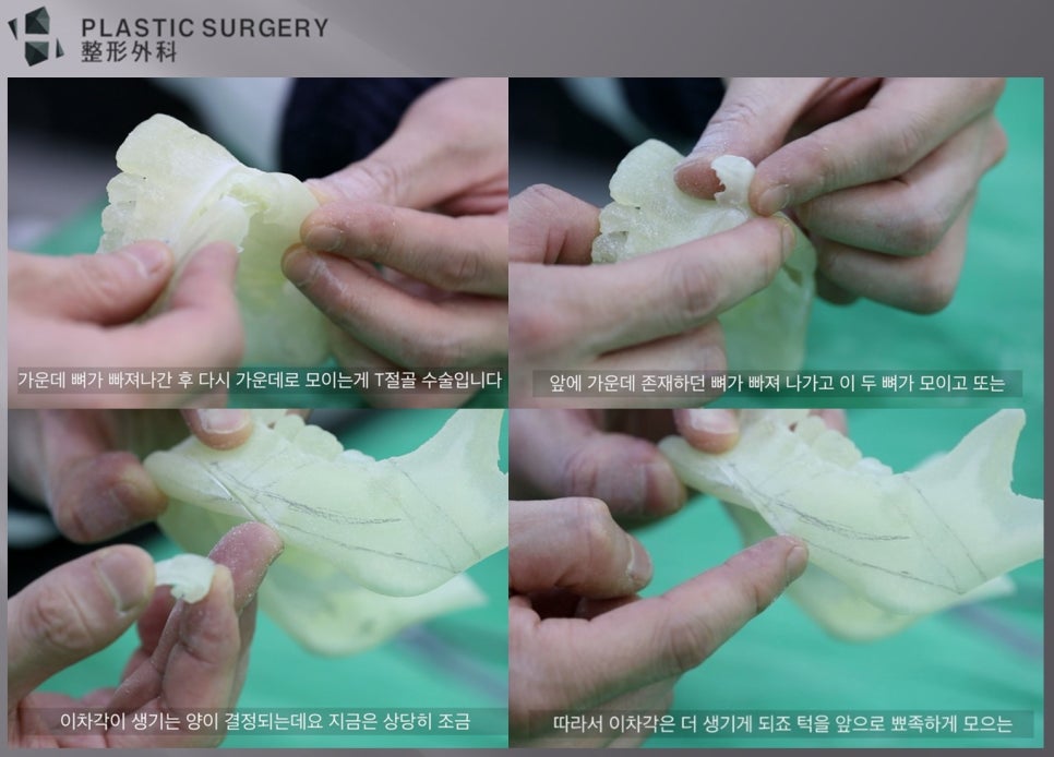 턱끝 T절골 골편 이동량과 이차각 발생 원인 설명도