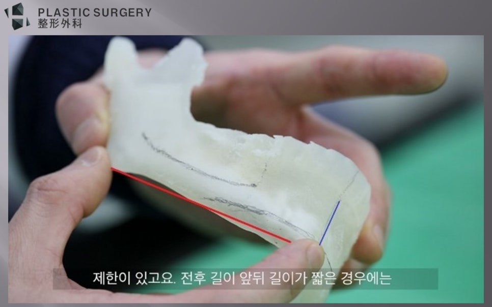 턱끝 수술 계획에 필요한 앞뒤 길이와 상하 길이 설명도