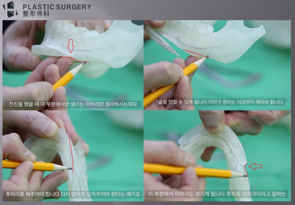 턱끝 전진술 후 하악체부에 생기는 이차각 모형