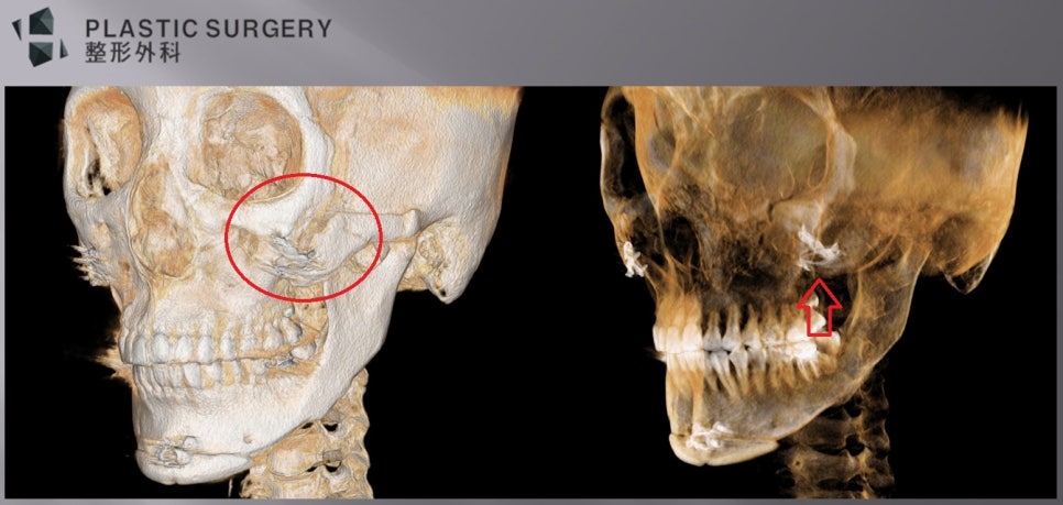 광대 체부 골결손이 동반된 불유합 3D CT 사례