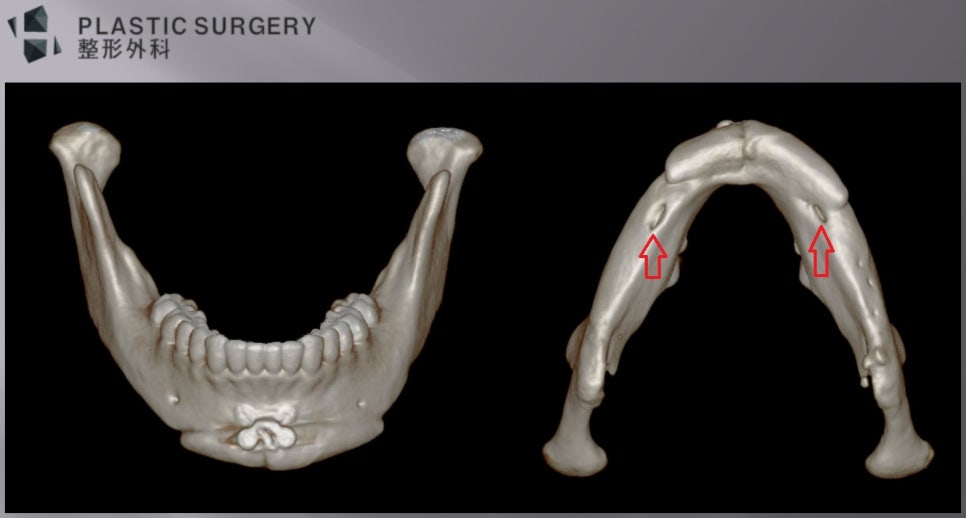 안면비대칭과 턱끝 연부조직 쏠림을 비교한 3D CT 투영 영상