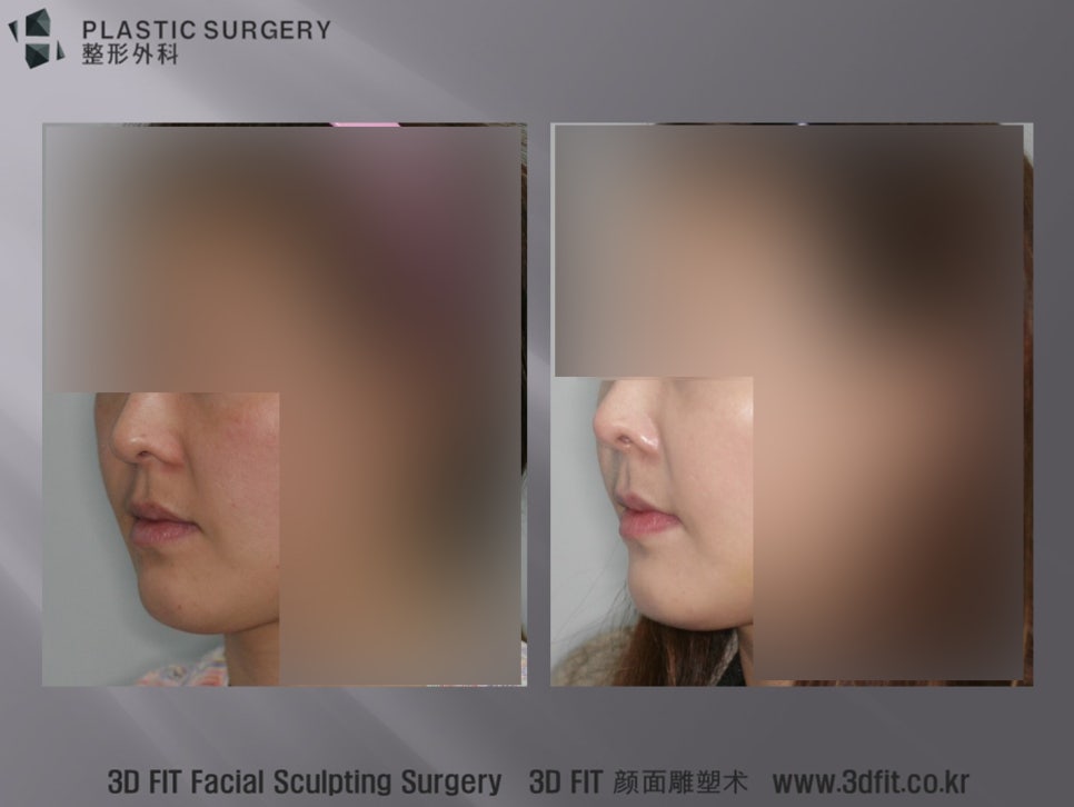 노화로 앞광대 볼륨이 감소한 환자의 수술 전후 사례