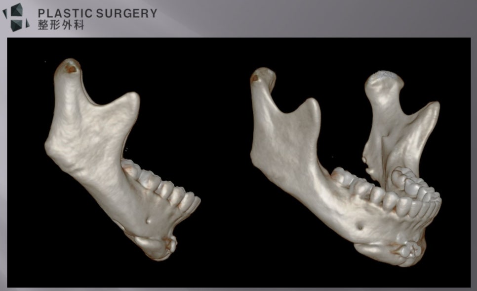 비대칭 T절골 고정과 하악체부 신경관 노출이 보이는 3D CT