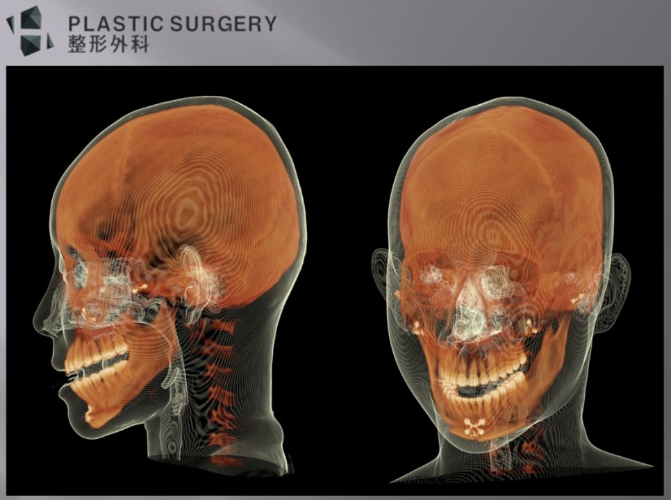 좌측 하악각 과절제와 하악체부 볼륨 감소가 보이는 3D CT