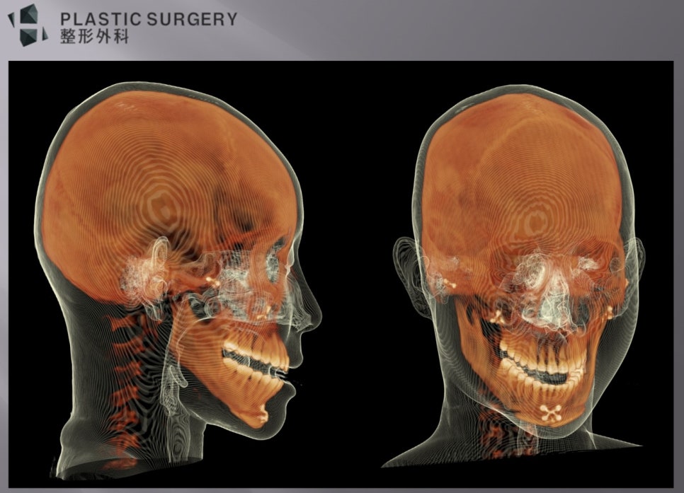 우측 하악각 과절제와 턱끝 계단 현상을 확인한 측면 3D CT