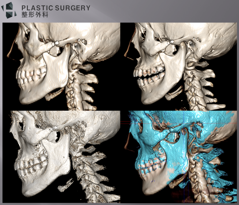 좌측 측면 하악각 재건 전후 3D CT 중첩 비교