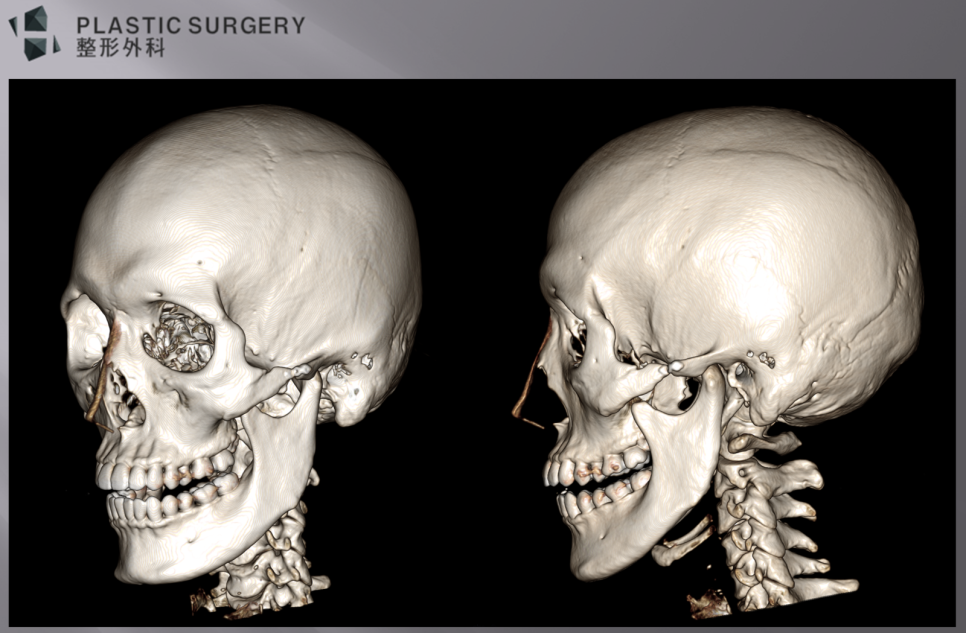 귀뒤 사각턱 수술 후 좌측 하악각 절제 상태 3D CT