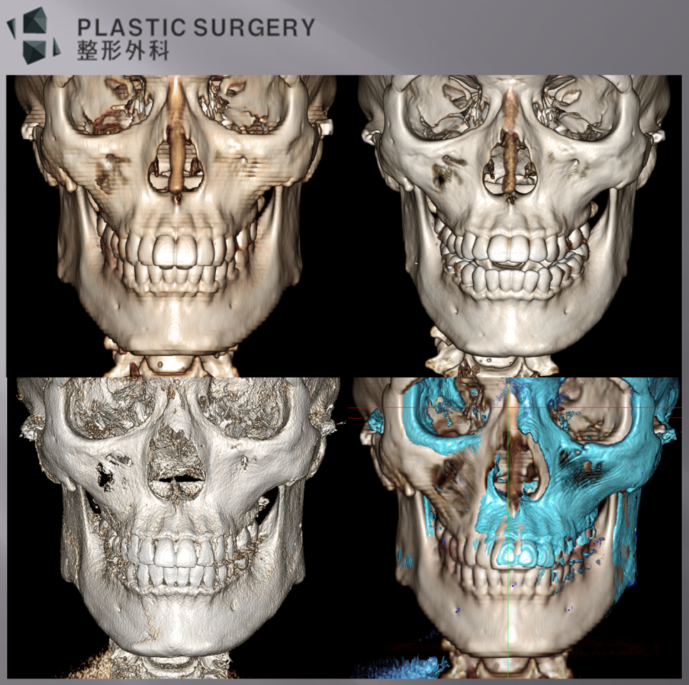 귀뒤 사각턱 수술 전·절제 후·재건 후 정면 3D CT 비교