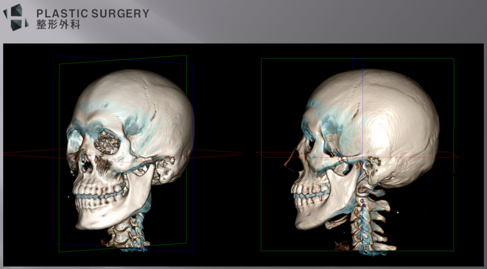 좌측 하악각 절제량을 확인한 수술 전 3D CT 중첩 영상