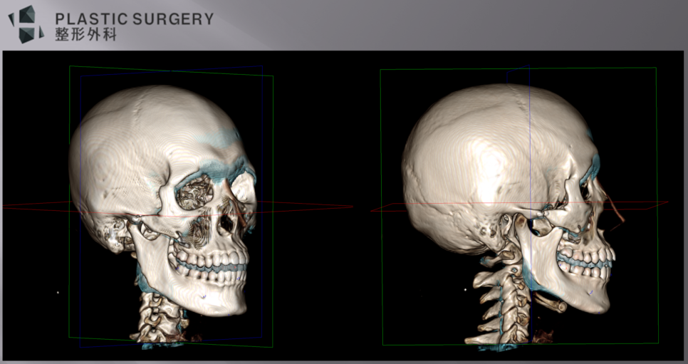 우측 하악각 절제량을 확인한 수술 전 3D CT 중첩 영상