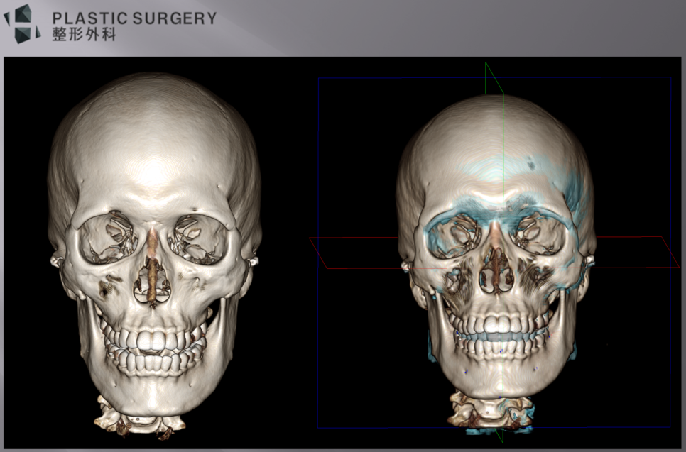 2013년 수술 전과 2015년 재건 전 3D CT 정면 중첩 영상