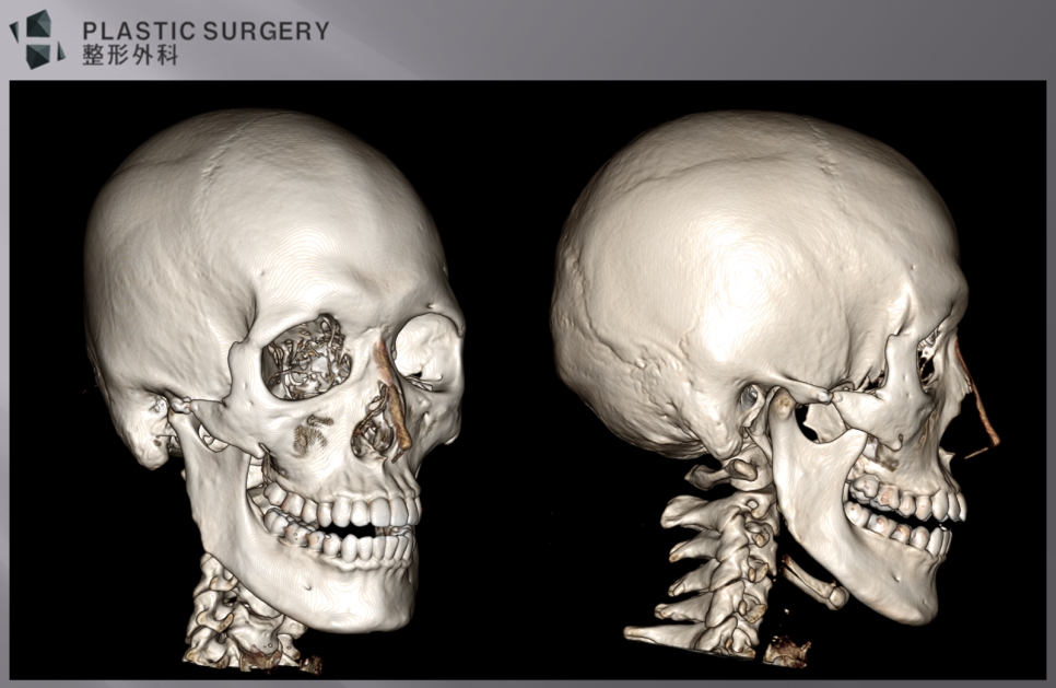 귀뒤 사각턱 수술 후 우측 하악각 절제 상태 3D CT
