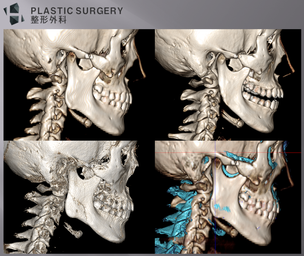 우측 측면 하악각 재건 전후 3D CT 중첩 비교