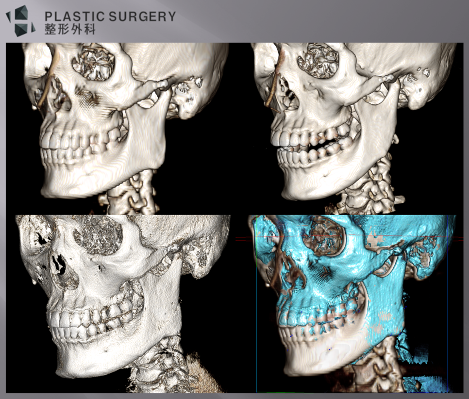 좌사면 하악각 재건 전후 3D CT 중첩 비교