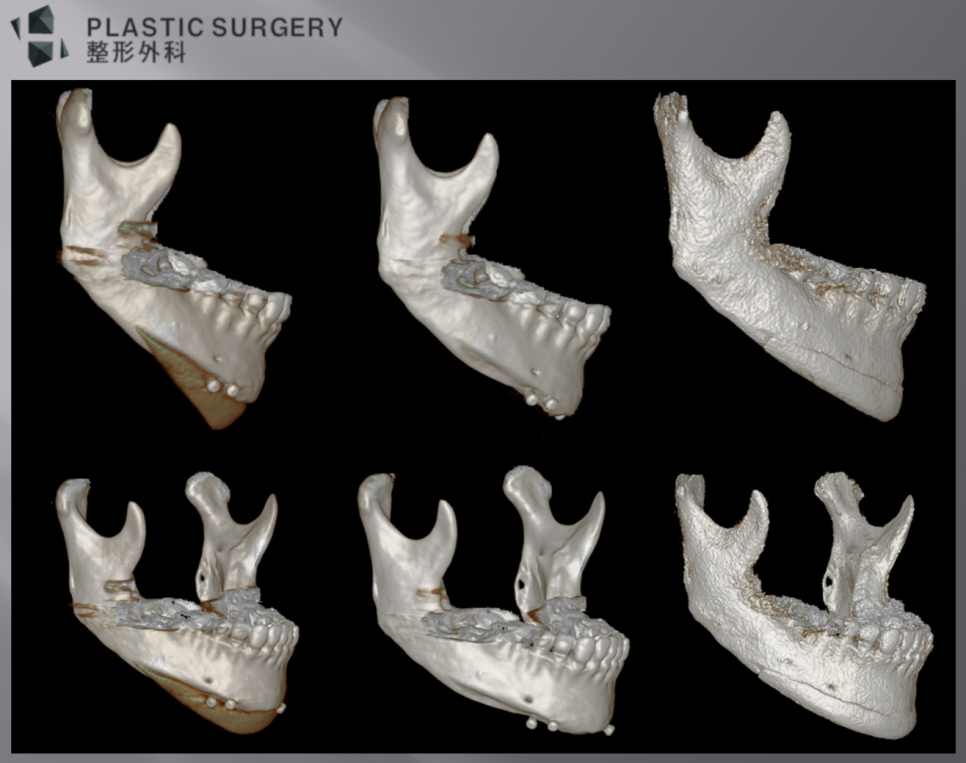 실리콘 보형물 변위·회전·뼈침식과 3D Fit 재건 비교