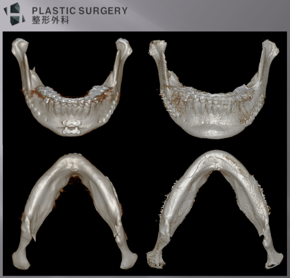 짧고 후진된 턱끝의 재건 전 측면 얼굴과 3D CT