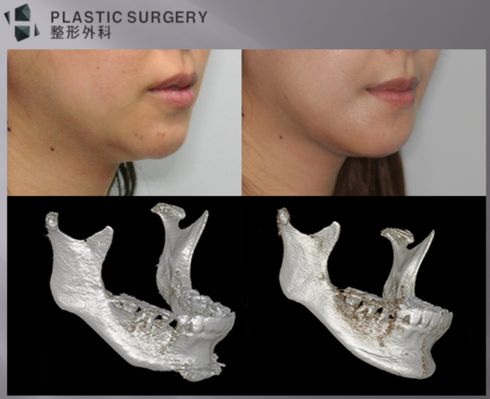 턱끝 재건 후 길이와 계단 현상 개선을 확인한 3D CT