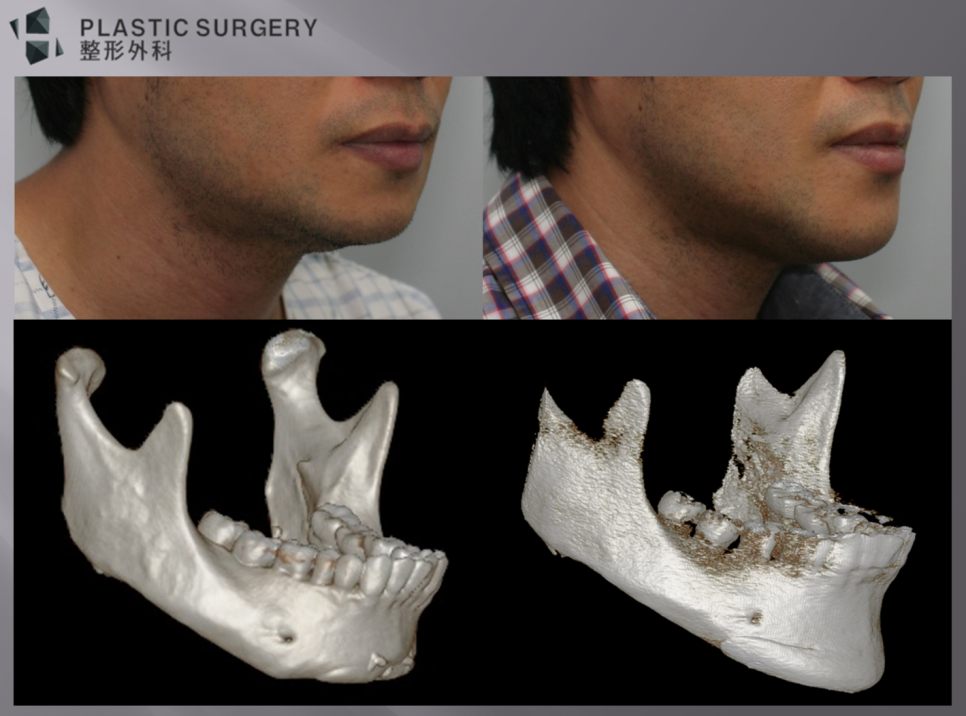 3D Fit 턱끝 재건 후 함몰과 턱선이 개선된 정면 비교