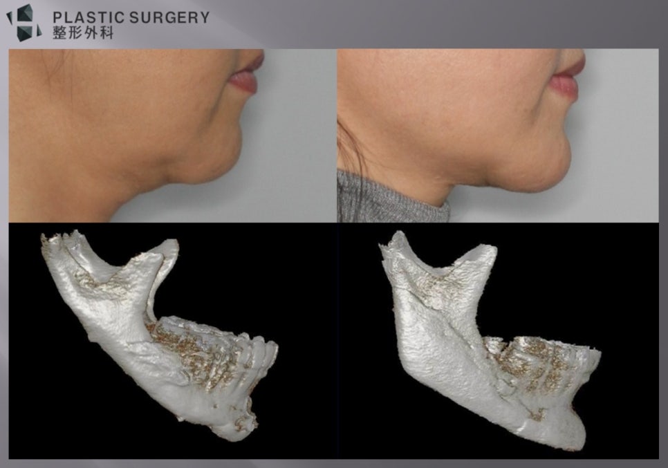 3D Fit 재건 후 턱끝 길이·이중턱·목턱각 변화 비교