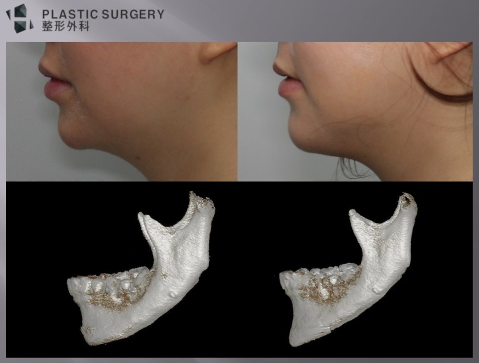 턱끝 길이 연장과 전진을 반영한 3D Fit 재건 전후 3D CT