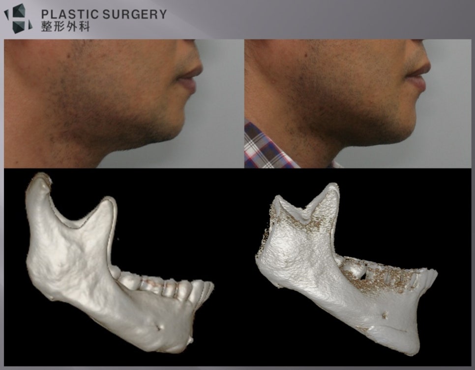 턱끝 재건 전후 연부조직과 3D CT 변화를 함께 본 비교