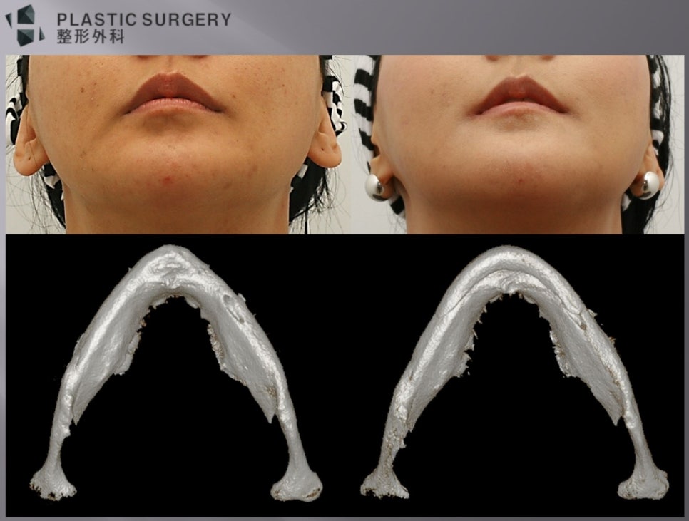 3D Fit 턱끝·하악각 재건 후 측면 턱선과 이중턱 비교