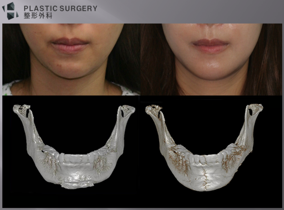 턱끝 T절골 후 비대칭·짧은 턱의 3D Fit 재건 전후 정면 비교