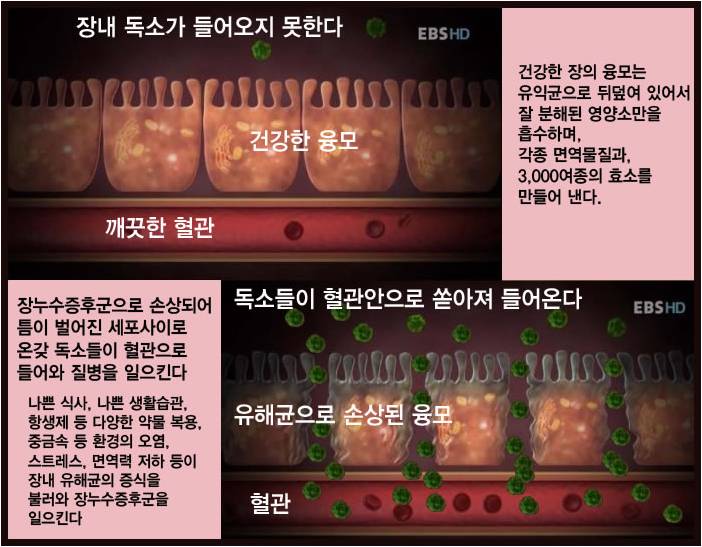아이비에스 (IBS) 이미지